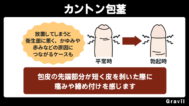 カントン包茎とは締め付けがある